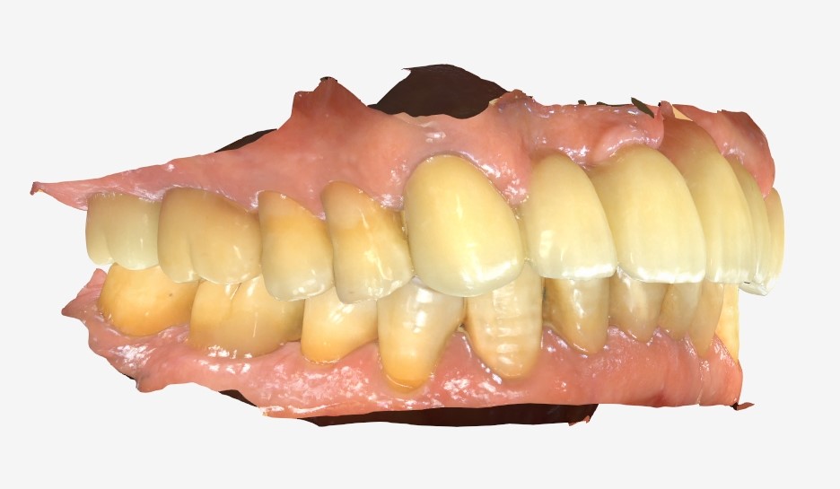 한남동 치과 디지털을 이용한 오차는 줄이고 편안함은 높이는 임플란트 관련 이미지 3