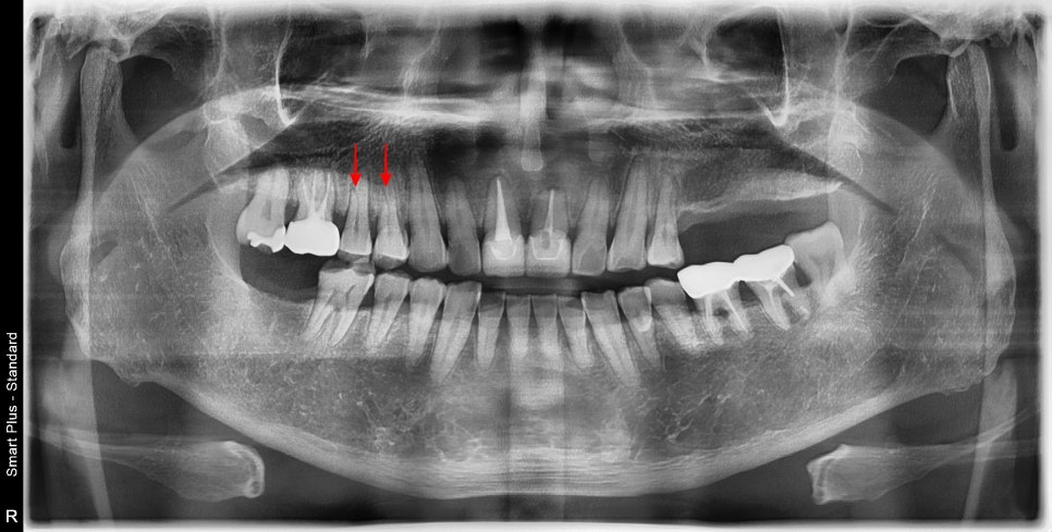 약수 임플란트, 씹을 때 갑작스러운 통증의 원인은? 관련 이미지 1