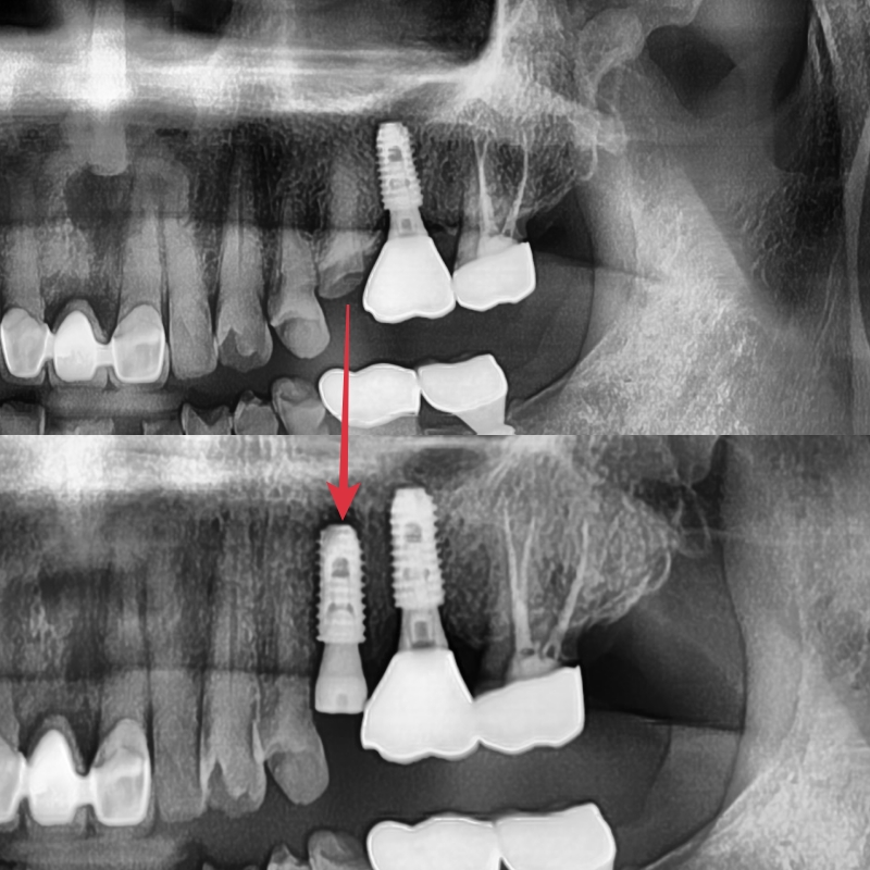 버티고개역 치과 깨지고 닳은 치아 회복하는 방법 관련 이미지 3