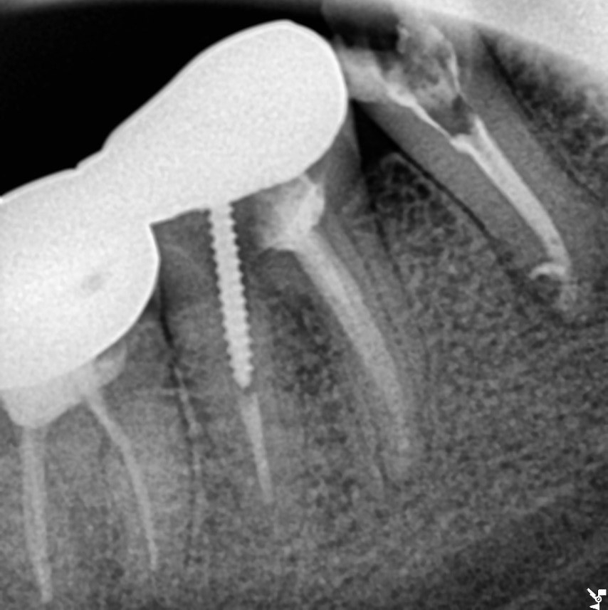 약수역 치과 오래된 신경치료 다시 하기 관련 이미지 4