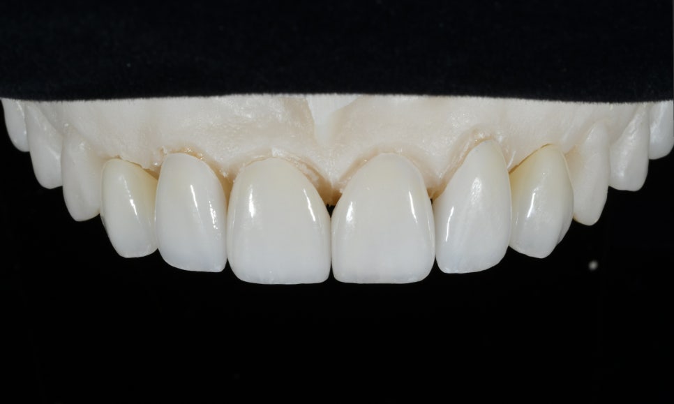 약수역 라미네이트 치과 선천적 왜소치 무삭제 치아 복원 관련 이미지 3