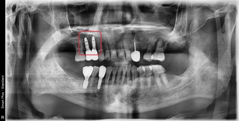 금호동 치과 신경치료된 치아 주변 염증 방치하면 안 되는 이유(발치후 임플란트) 관련 이미지 4