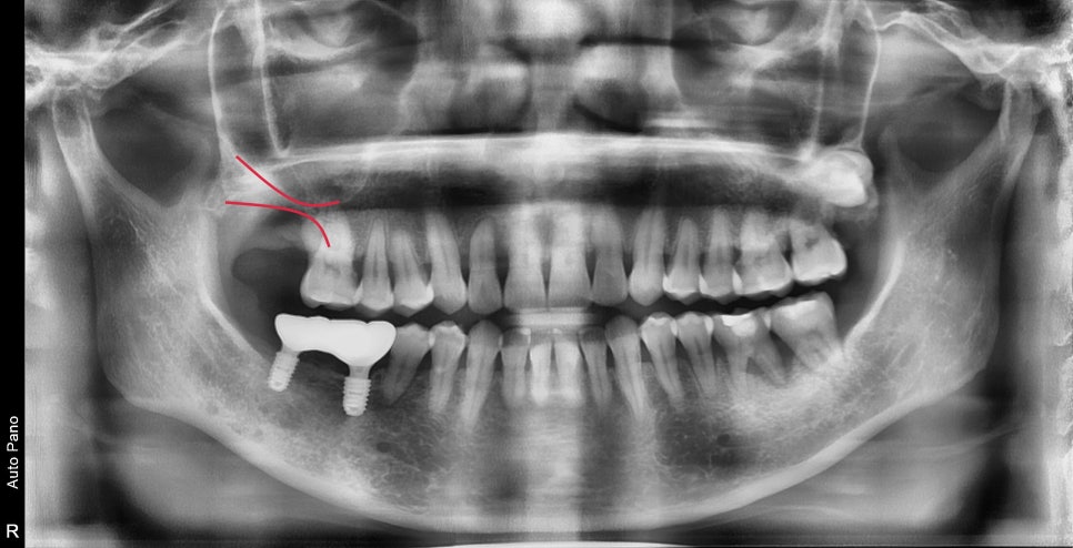 약수동 임플란트 염증으로 인한 발치 후 임플란트 식립( 상악동 거상술) 관련 이미지 4