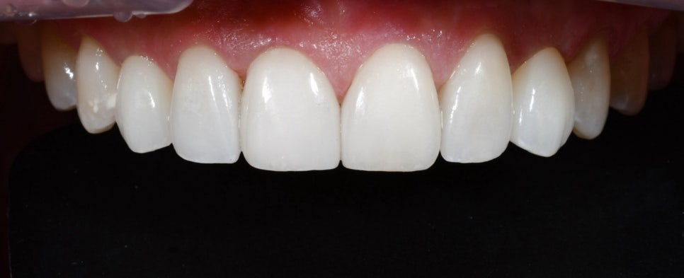 청구동 치과 앞니 라미네이트를 하는 이유 관련 이미지 7