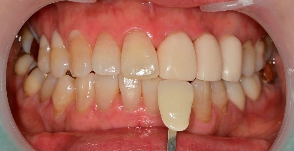 약수역 치과 오래된 앞니 크라운 재보철치료시 주의할 사항 관련 이미지 5
