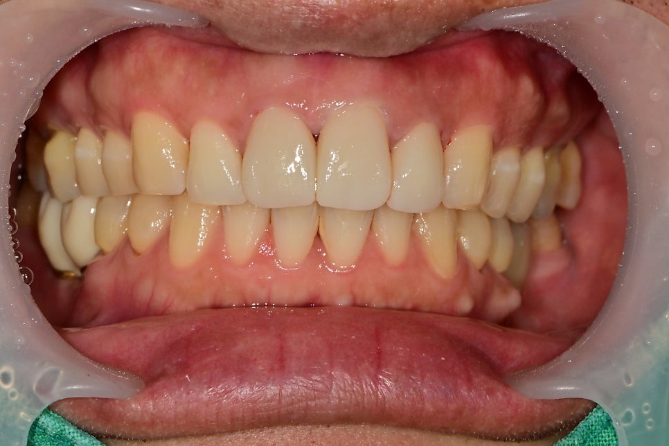 약수역 치과 , 전치부 심미보철 재제작할때 주의할 점 ( 항상 무삭제 라미네이트가 가능한 것인가??) 관련 이미지 4