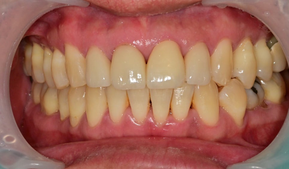 한남동 주변 치과 외상에 의해 앞니가 깨졌을 때 범위에 따른 치료방법 관련 이미지 6