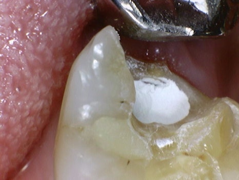 약수역치과 깊은 충치 신경치료 없이 치료하는 방법( MTA치료 ) 관련 이미지 5