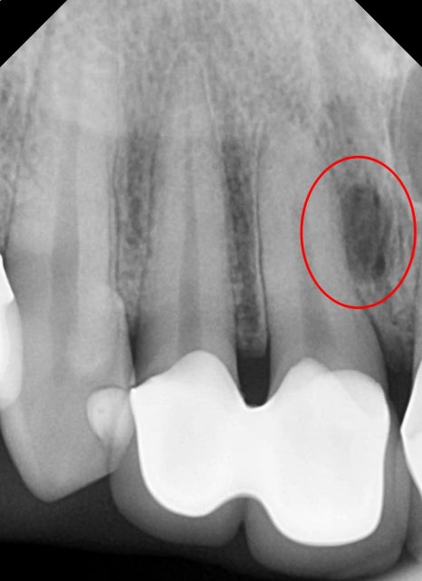 신당동 치과, 앞니 보철치료시 주의할 점(심미보철, 신경치료) 관련 이미지 2