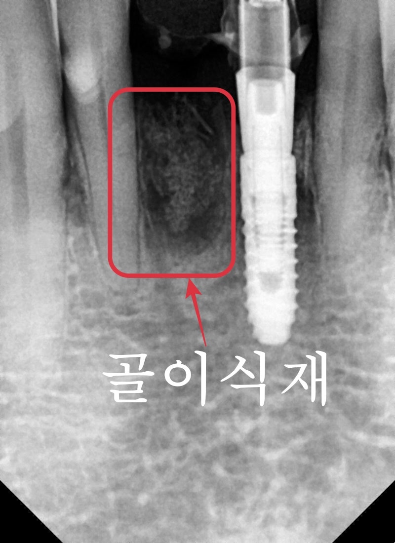 성동구 옥수동 치과 앞니 임플란트수술 즉시 임시치아 제작(구강스캐너를 이용한 수술절차) 관련 이미지 7