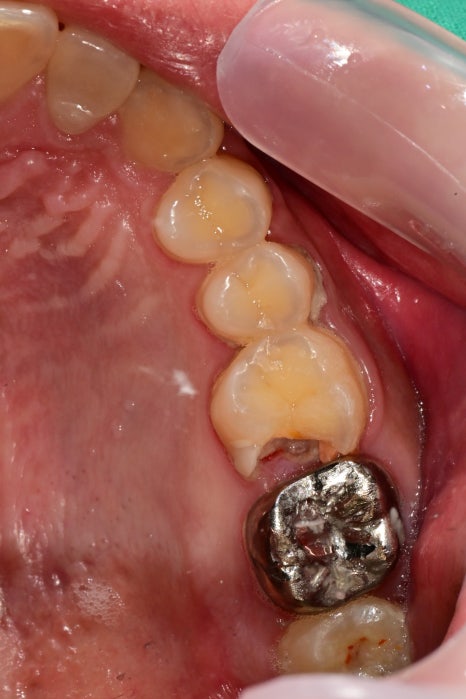 금남시장 치과, 잇몸염증이 생긴다면 원인과 치료 방법은?? ( 양치할 때 피나요, 치아색이 이상해요) 관련 이미지 5