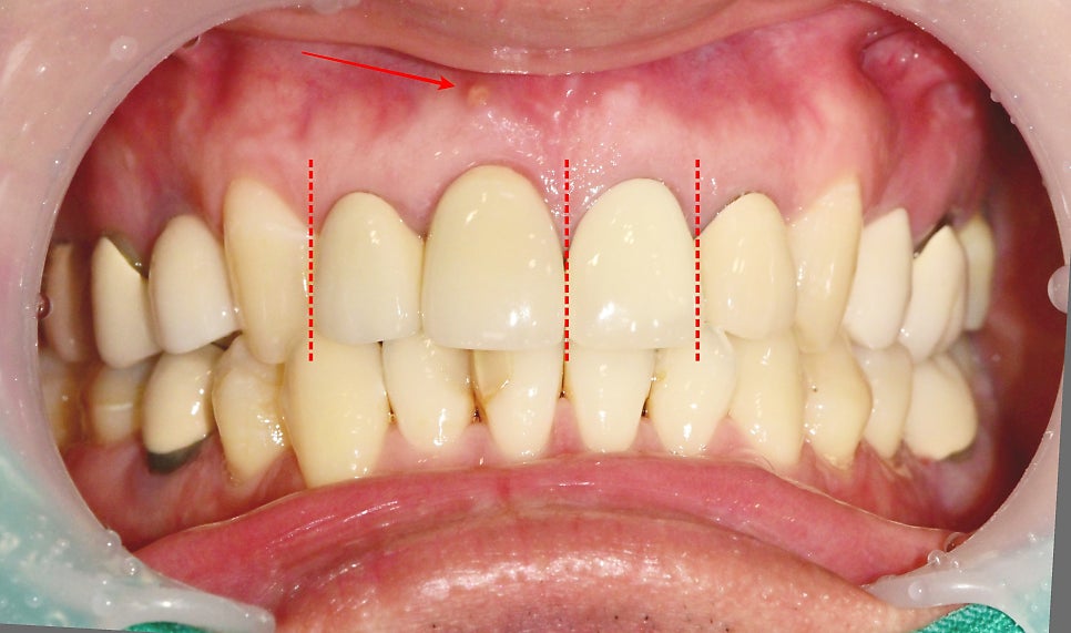 신당동 치과, 앞니 보철치료시 주의할 점(심미보철, 신경치료) 관련 이미지 1
