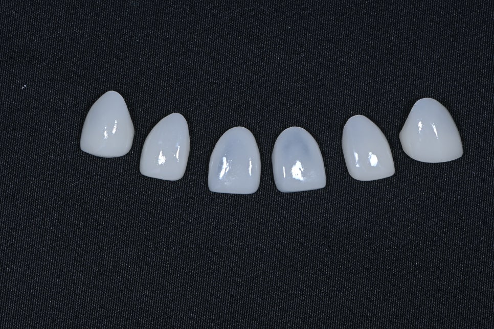 동대문 무삭제라미네이트 과거 교정한 치아가 웃을 때 안 보여 스트레스일 때 관련 이미지 5