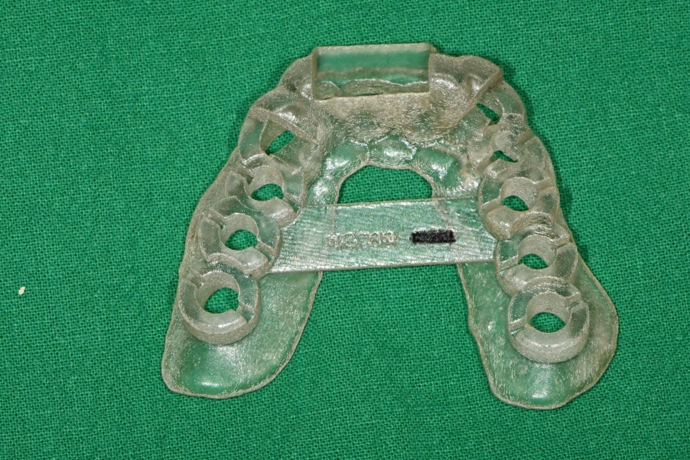 신당 임플란트, 심을까 말까 고민되신다면?? (고난도 골이식 임플란트 기간 및 통증) 관련 이미지 9