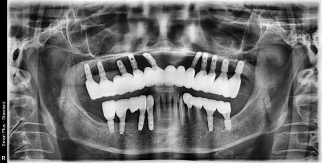 약수동 치과, 전체틀니 오래 쓰신분들 전체 임플란트 가능한가요??(치조골의 흡수양상과 모양) 관련 이미지 7
