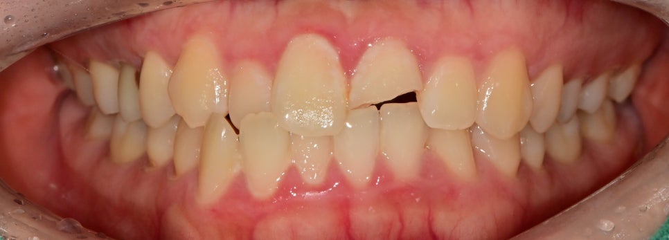 한남동 주변 치과 외상에 의해 앞니가 깨졌을 때 범위에 따른 치료방법 관련 이미지 1