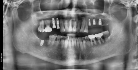 약수 임플란트, 씹을 때 갑작스러운 통증의 원인은? 관련 이미지 4