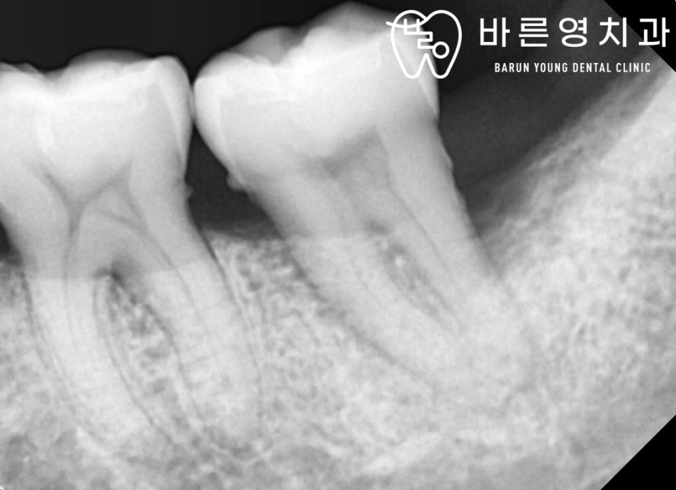 옥수역치과, 충치치료 조기에 해야 자연치아 보존률 UP! 관련 이미지 11