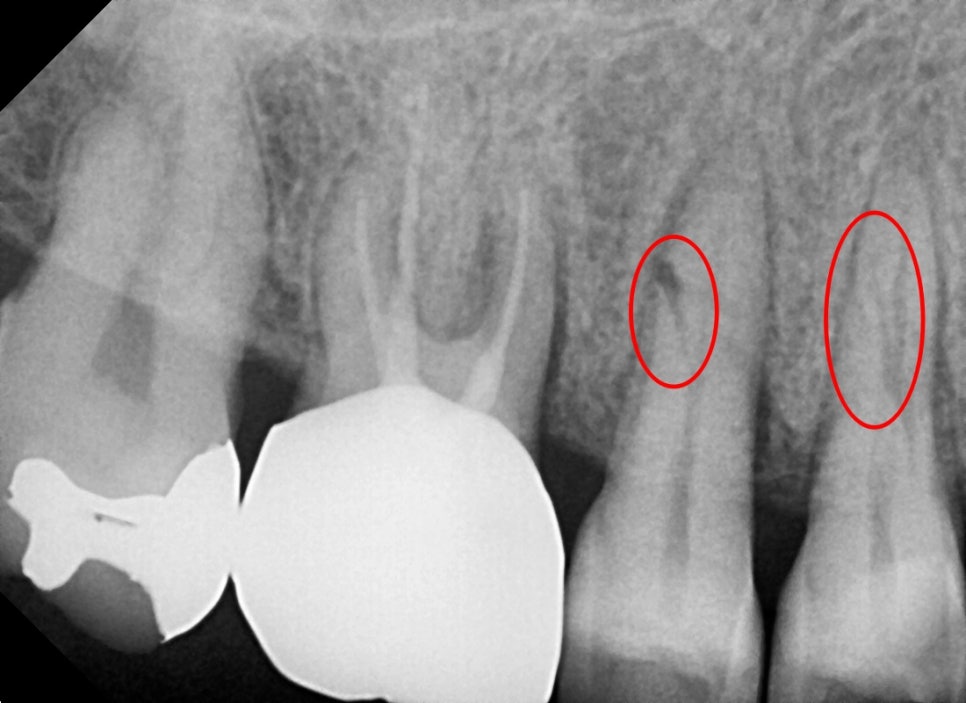 약수 임플란트, 씹을 때 갑작스러운 통증의 원인은? 관련 이미지 2
