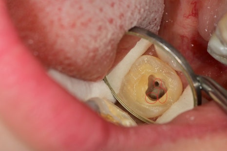 약수역 치과, 어려운 신경형태의 치아 신경치료 할때 주의할점 ( C형 근관, 신경관 찾기, 치아보존치료) 관련 이미지 6