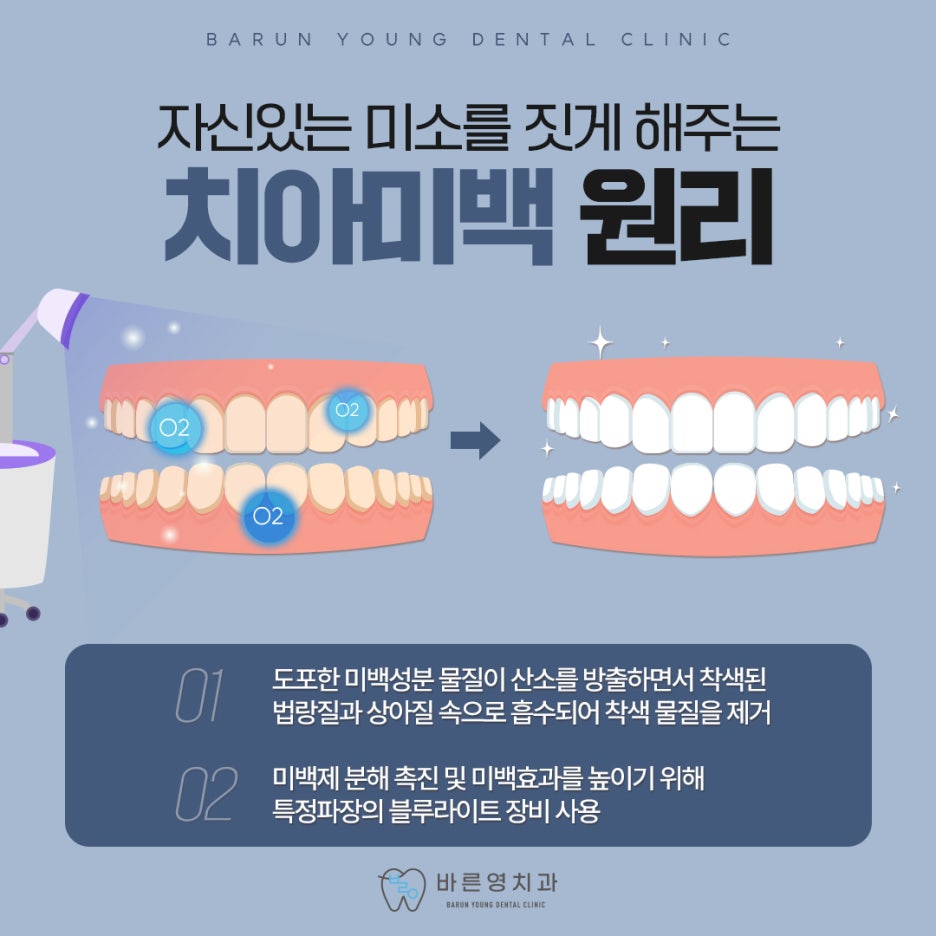 금호동치과 자연스러운 치아미백 치료를 돕는 바른영치과 관련 이미지 3
