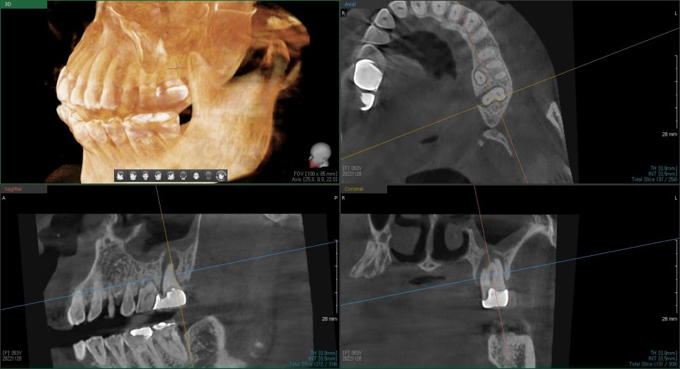 약수역 치과, 신경치료된 치아 뿌리 주변 염증이 생겼을 때 발치 후 발치와 보존술 처치( 임플란트 식립을 위한 치료 ) 관련 이미지 3