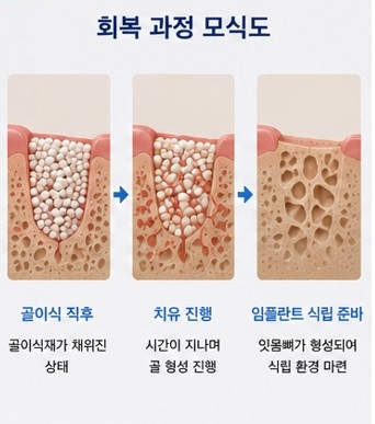약수역 임플란트, 뼈이식 없이 가능한 경우도 있을까요? 관련 이미지 3