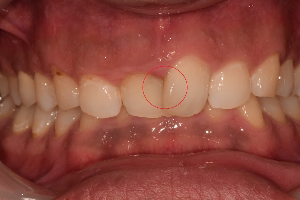 약수동 치과, 삐뚤어진 앞니가 충치가 생겨 치료 후 보철로 가지런한 치아 만들기 관련 이미지 1