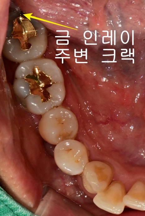 광희동 주변 치과 치아 크랙으로 인한 증상 신경치료 관련 이미지 2