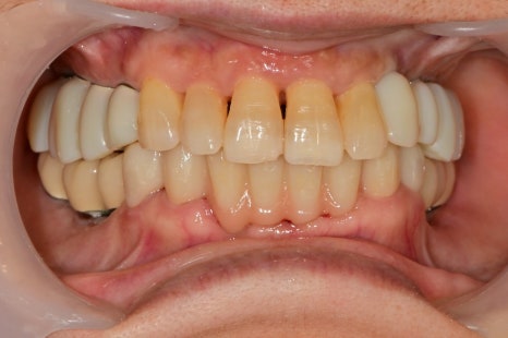 신당 임플란트, 심을까 말까 고민되신다면?? (고난도 골이식 임플란트 기간 및 통증) 관련 이미지 12