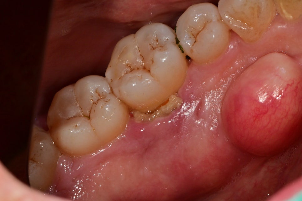 약수동 치과, 치주 질환이 진행된 잇몸에서 항상 붓고 피가 나는 이유(잇솔질, 워터픽, 잇몸치료) 관련 이미지 6
