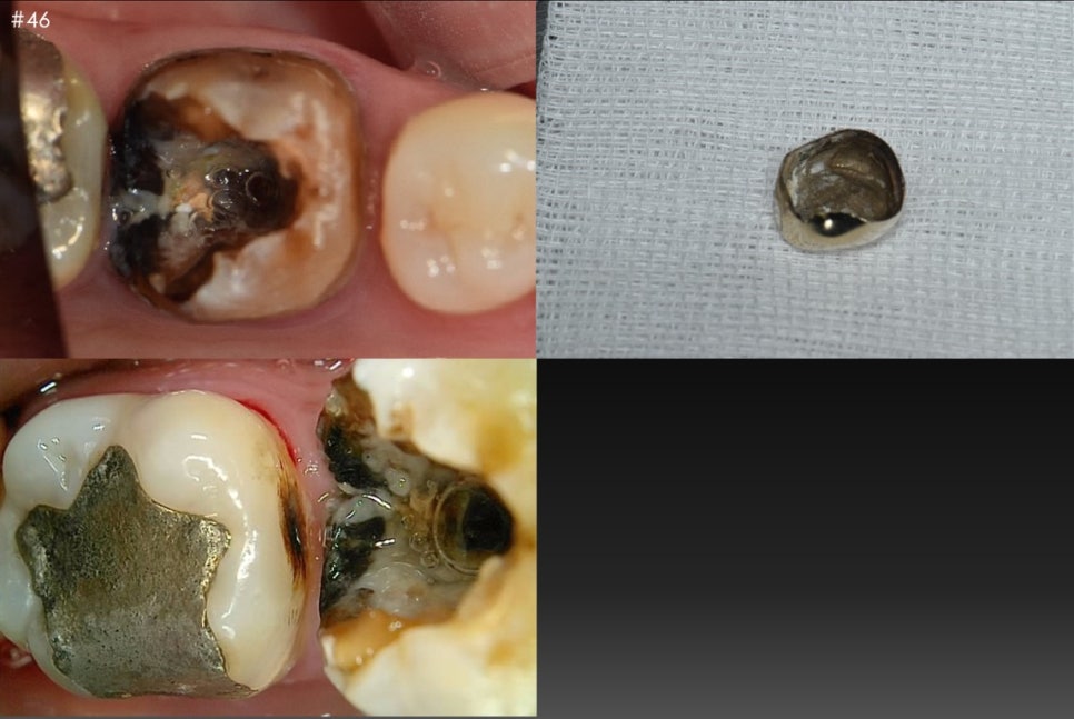 옥수동 치과, 신경치료 돼있는 치아 잇몸의 염증, 고름주머니가 생겼을 때 약을 먹어도 안 가라앉아요. ( 생기는 원인과 치료방법) 관련 이미지 3