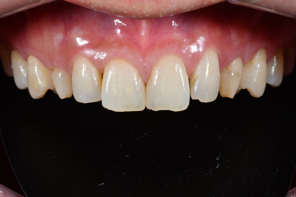청구동 치과 앞니 라미네이트를 하는 이유 관련 이미지 5