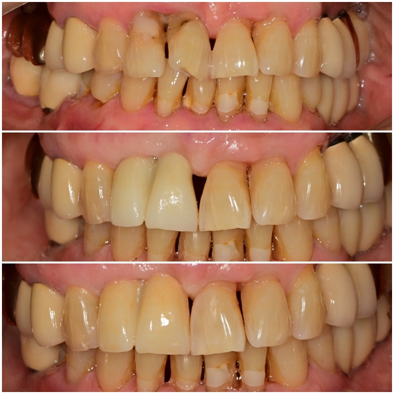 약수동 치과 내려앉은 잇몸 공간 치아삭제 없이 치료하기 관련 이미지 10