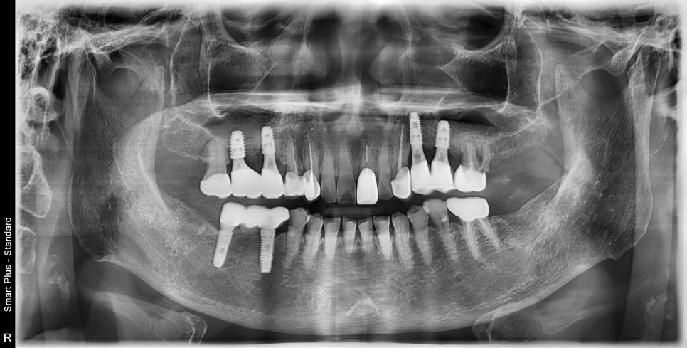 신당 치과 틀니보다 임플란트가 좋은 이유 관련 이미지 4