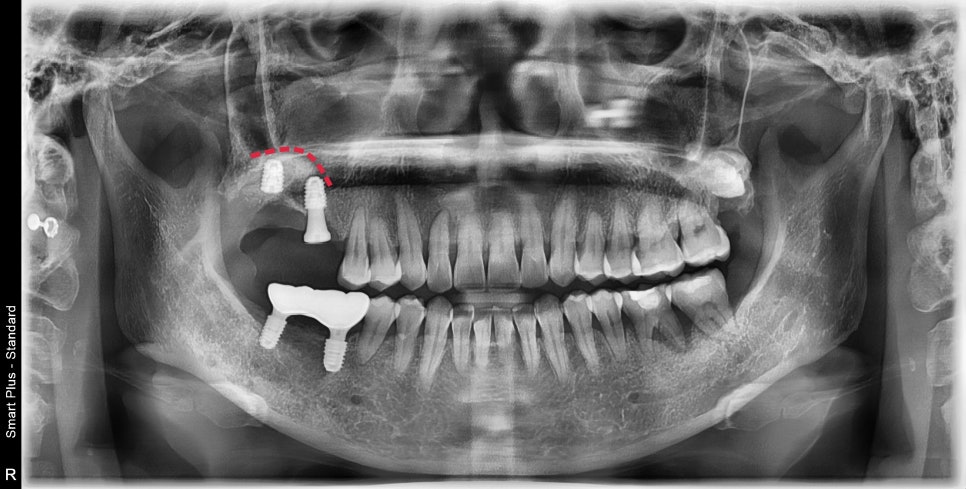 약수동 임플란트 염증으로 인한 발치 후 임플란트 식립( 상악동 거상술) 관련 이미지 5