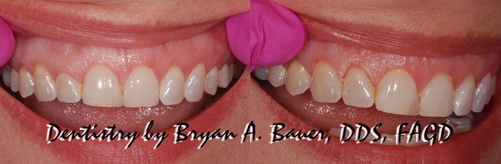 약수동 치과, 삐뚤어진 앞니가 충치가 생겨 치료 후 보철로 가지런한 치아 만들기 관련 이미지 5