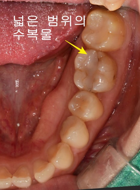 광희동 주변 치과 치아 크랙으로 인한 증상 신경치료 관련 이미지 5