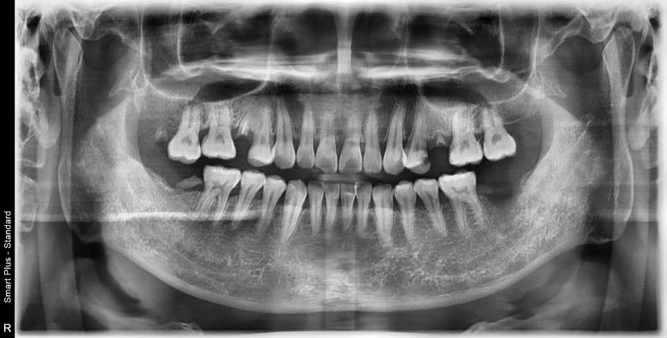 장충동 주변 치과 오래된 충치, 빠진 치아 부위 치료 방법 관련 이미지 1