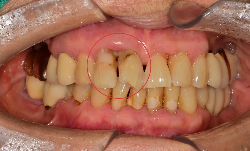 약수동 치과 내려앉은 잇몸 공간 치아삭제 없이 치료하기 관련 이미지 2