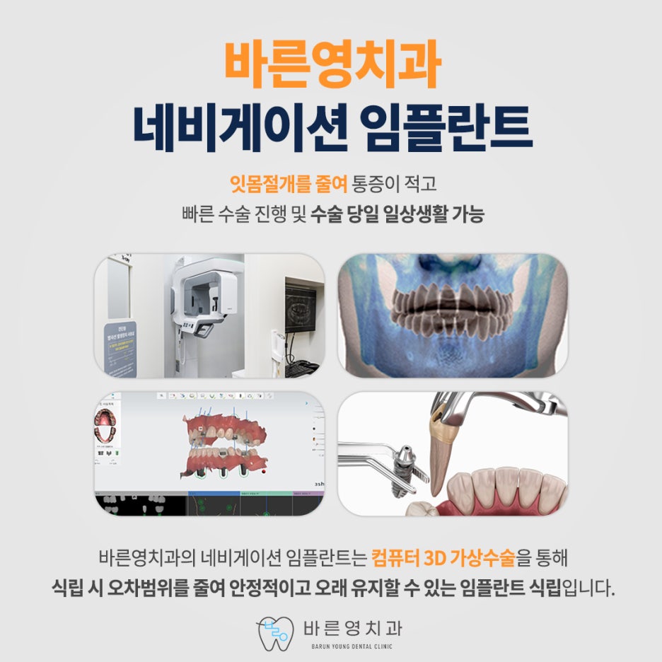 약수역치과 네비게이션 임플란트로 잃어버린 치아 대신 관련 이미지 9