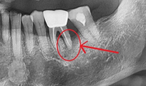 옥수동 치과, 신경치료 돼있는 치아 잇몸의 염증, 고름주머니가 생겼을 때 약을 먹어도 안 가라앉아요. ( 생기는 원인과 치료방법) 관련 이미지 6