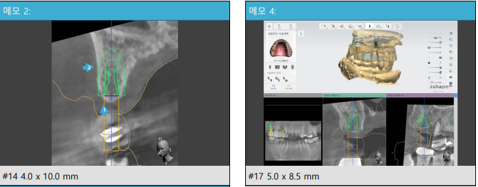 신당 임플란트, 심을까 말까 고민되신다면?? (고난도 골이식 임플란트 기간 및 통증) 관련 이미지 3