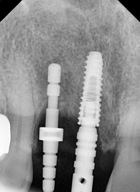 약수동 치과 내려앉은 잇몸 공간 치아삭제 없이 치료하기 관련 이미지 4