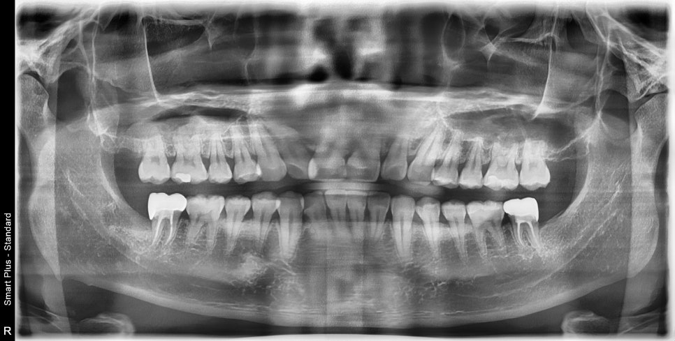 약수역 치과, 매복 사랑니 발치 (신경치료, 크라운치료) 관련 이미지 4