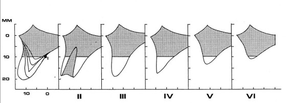 약수동 치과, 전체틀니 오래 쓰신분들 전체 임플란트 가능한가요??(치조골의 흡수양상과 모양) 관련 이미지 3