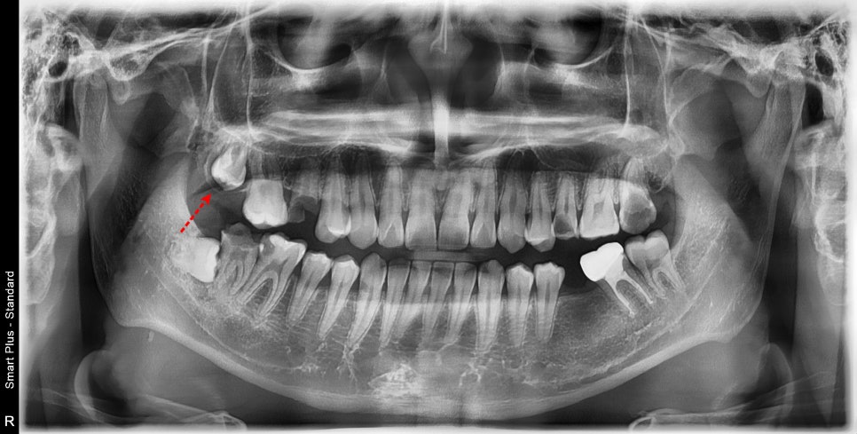 금호동 논골사거리 근처 치과에서 영구치 치료를 위한 잇몸성형술 관련 이미지 2