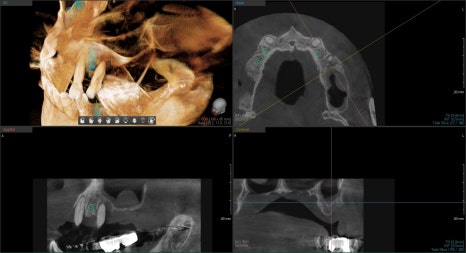 약수역치과 전체임플란트 진행과정 (상악동 거상술) 관련 이미지 5