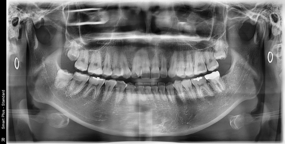 청구역 치과, 충치가 생긴 치아를 초기에 치료를 미루면 안되는 이유!! ( 신경염증, 뿌리주변 염증, 보철치료를 위한 사랑니 발치) 관련 이미지 4
