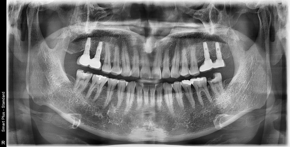 장충동 치과, MTA를 이용한 신경치료 시 주의할 점( 크랙치아, 깊은 충치) 관련 이미지 5